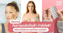 External Link: กินยาคุมแล้วเป็นฝ้า ทำยังไงดี พร้อมวิธีเลือกยาคุมที่ช่วยลดการเกิดฝ้า | บทความของ CutenessCorner | SistaCafe ครบเครื่องเรื่องบิวตี้