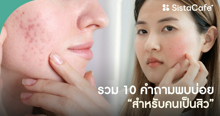 External Link: รวม 10 คำถามพบบ่อย สำหรับคนเป็นสิว | บทความของ SIS GURU | SistaCafe ครบเครื่องเรื่องบิวตี้