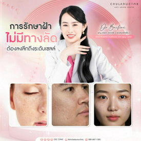 รูปภาพหน้าปกบทความ:SMAPS เทคนิครักษาฝ้ากระ กวนใจ สิทธิบัตรเฉพาะจาก Chula Doctor