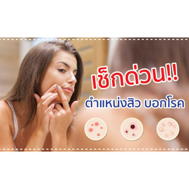 รูปภาพหน้าปกบทความ:เช็กด่วน! ตำแหน่งสิว บอกโรค