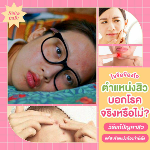 รูปภาพหน้าปกบทความ:ไขข้อข้องใจ ❗ ตำแหน่งสิวบอกโรคจริงหรือไม่? พร้อมกับวิธีแก้ปัญหาสิวแต่ละตำแหน่งต้องทำยังไง