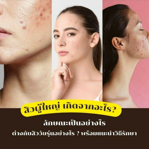 รูปภาพหน้าปกบทความ:สิวผู้ใหญ่ เป็นทีไรหายยากทุกที ! ไขข้อสงสัยสิววัยผู้ใหญ่ อยากกู้ผิวเนียนใสทำยังไงดี ?