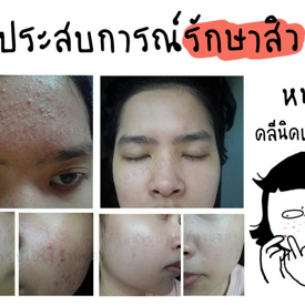 รูปภาพหน้าปกบทความ:แชร์ประสบการณ์รักษาสิว! หน้าพังเพราะสบู่เน็ตไอดอล ลองมาเกือบทุกวิธี สุดท้ายก็หายซะที!!!!