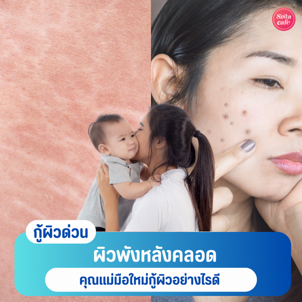 รูปภาพหน้าปกบทความ:ผิวพังหลังคลอด คุณแม่มือใหม่กู้ผิวอย่างไรดี ?