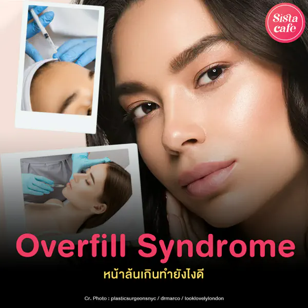 รูปภาพหน้าปกบทความ:Overfill Syndrome หน้าล้นเกินจนเลยธรรมชาติ ปากหรือไส้กรอกรมควัน ?