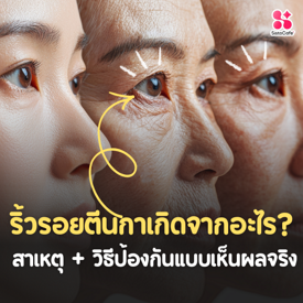 รูปภาพหน้าปกบทความ:ริ้วรอยตีนกาเกิดจากอะไร? สาเหตุ + วิธีป้องกันแบบเห็นผลจริง