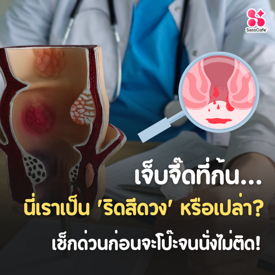 รูปภาพหน้าปกบทความ:เจ็บจี๊ดที่ก้น... นี่เราเป็น 'ริดสีดวง' หรือเปล่า? เช็กด่วนก่อนจะโป๊ะจนนั่งไม่ติด!