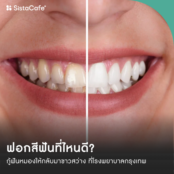 รูปภาพหน้าปกบทความ:ฟอกสีฟันที่ไหนดี? กู้ฟันหมองให้กลับมาขาวสว่าง ที่โรงพยาบาลกรุงเทพ