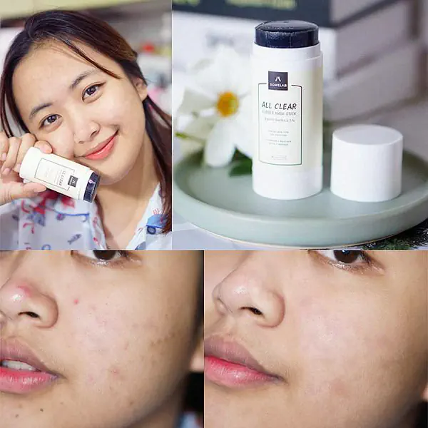 รูปภาพหน้าปกบทความ:ลบสิวให้หน้าใสภายใน 30 วิ! ด้วยมาส์กยางลบ Somelab All Clear Rubber Mask Stick สิวหลุด ไม่มีเหลือ!