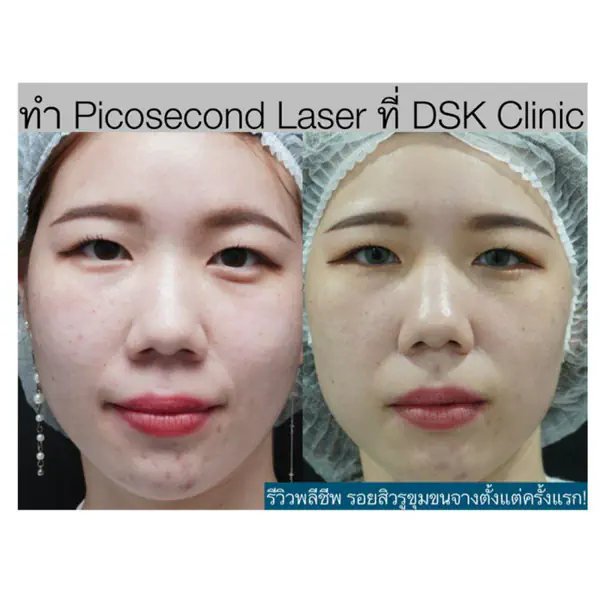 รูปภาพหน้าปกบทความ:รีวิวพลีชีพ! ทำ Picosecond Laser รักษารอยสิว