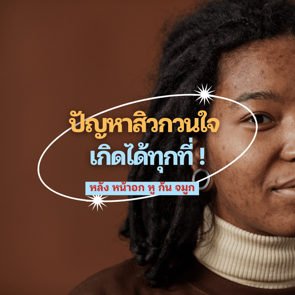 รูปภาพหน้าปกบทความ:อย่าปล่อยทิ้งไว้! รู้สาเหตุพร้อมวิธีรักษา " สิวตามร่างกาย " สัญญาณเตือนบอกโรค 😖