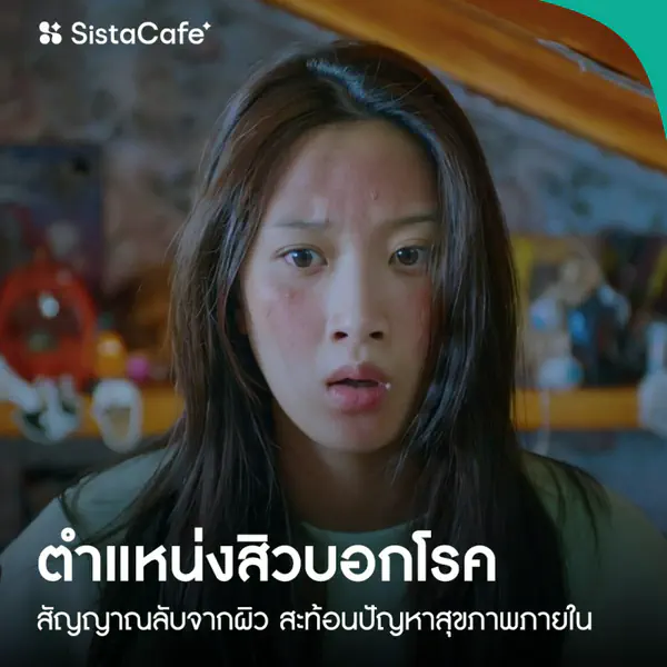 รูปภาพหน้าปกบทความ:ตำแหน่งสิวบอกโรค สัญญาณลับจากผิว สะท้อนปัญหาสุขภาพภายใน