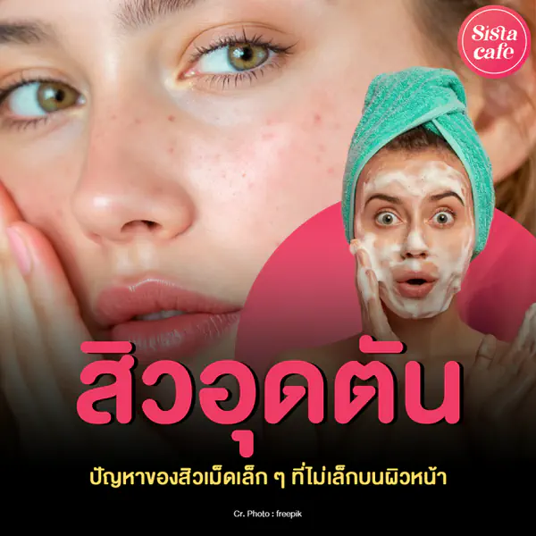 รูปภาพหน้าปกบทความ:สิวอุดตัน คืออะไร ? ปัญหาของสิวเม็ดเล็ก ๆ ที่ไม่เล็กบนผิวหน้า