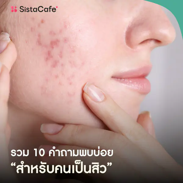 รูปภาพหน้าปกบทความ:รวม 10 คำถามพบบ่อย สำหรับคนเป็นสิว