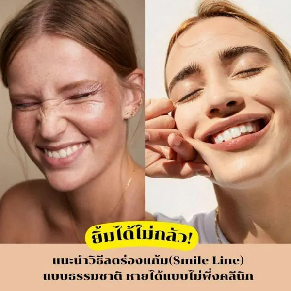 รูปภาพหน้าปกบทความ:วิธีลดร่องแก้ม Smile Line ยิ้มได้ไม่กลัว หายธรรมชาติแบบไม่พึ่งคลินิก